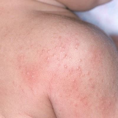 Heat rash is characterized by red skin and itching sensation, often associating with small bumps and some changes in the skin texture. Baby Skin Issues and Conditions | What to Expect