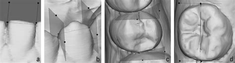 Buccolingual mesiodistal maxillary second premolar maxillary first premolar 38% type i > ii > iii buccolingual anteriors type i mesiodistal outline form errors root number: Measurements of mesiodistal width of (a) incisor, (b ...