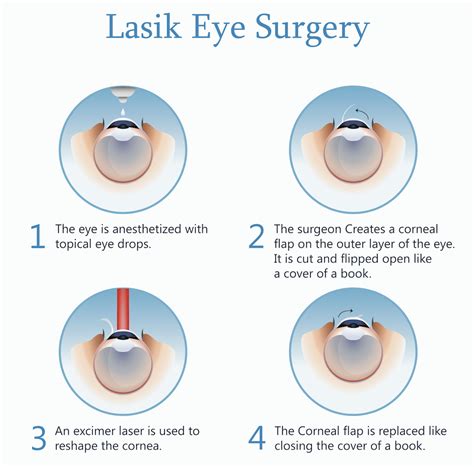 During cataract surgery, your cloudy natural lens is removed and replaced with a clear artificial lens. Procedure - Laser eye surgery (LASIK)