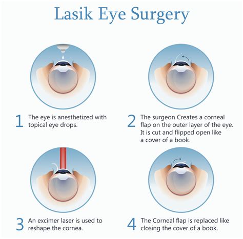 You might feel some discomfort or notice blurry vision. Procedure - Laser eye surgery (LASIK)