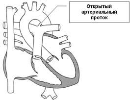 In den westlichen industrieländern ist die koronare herzkrankheit mit ihren folgen die häufigste. Angeborene Herzfehler: persistierender Ductus arteriosus ...