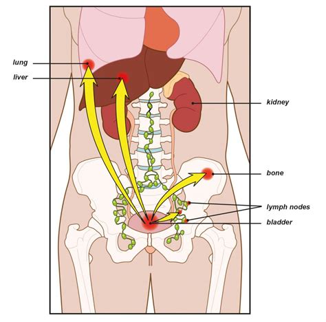 If the lymph nodes are involved or multiple tumors are found at the time of diagnosis, survival time is shortened to only 2 months. Metastatic cancer eyes symptoms. Cloudy Urine, Metastatic ...