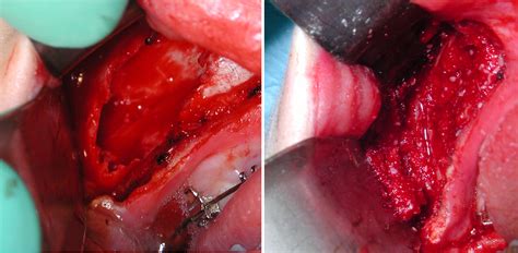 Summary an aneurysmal bone cyst is rare in the patella. Aneurysmal Bone Cyst Excision and Reconstruction intraop Dr Barry Eppley Indianapolis - Explore ...