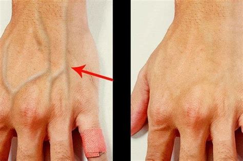 Check spelling or type a new query. 70+ Gambar Tangan Orang Kena Infus Terbaik - Top Koleksi Gambar