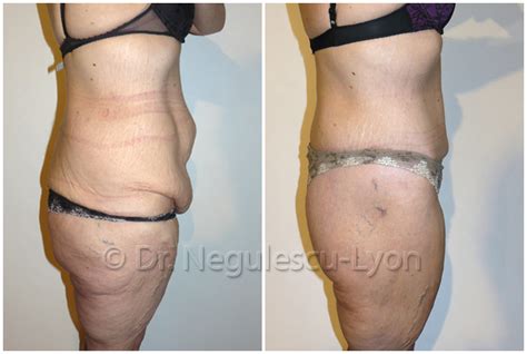 Liposuccion tunisie prix , prix liposuccion pas cher , tarif liposuccion en tunisie , coût liposuccion complète tunisie meilleur chirurgien avis , lipo ventre. Bodylift à Lyon: abdominoplastie totale | Dr. Vlad NEGULESCU