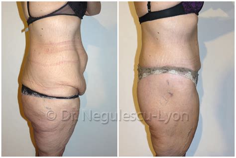 Une liposuccion du ventre promet des résultats stupéfiants après une seule intervention. Bodylift à Lyon: abdominoplastie totale | Dr. Vlad NEGULESCU