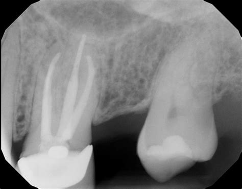 How does root insurance work. Retreat Or Redo Root Canal Treatments - Soft Dental, Rush City Dentist