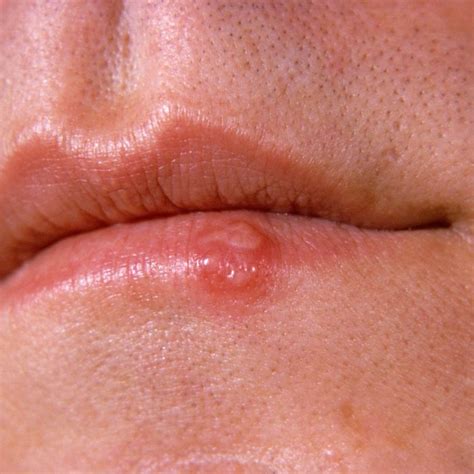 Oral herpes on the tongue will go away on its own, but having said that, the sores can be quite painful and irritating. Red Ring Around Lips Std | Lipstutorial.org