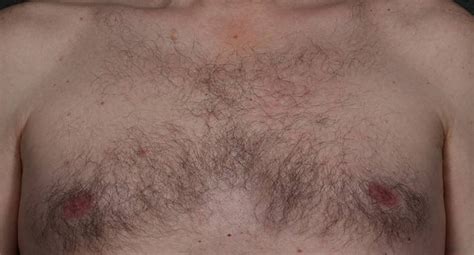 3.6 out of 5 stars. 2 Laser Hair Removal Before and After Photos - Los Angeles ...