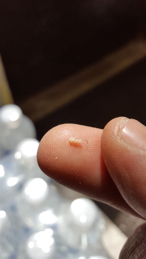 A hair is ingrown when it either grows back down into your dog's skin or fails to break through the dog's skin and winds up growing sideways within the skin. Ingrown hair on my leg from work boots. Sweet relief ...