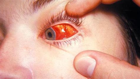 Die virale konjunktivitis geht häufig mit erkältungskrankheiten einher, die häufigste ursache sind sogenannte adenoviren. Virale Konjunktivitis: Symptome und Behandlung für Kinder ...