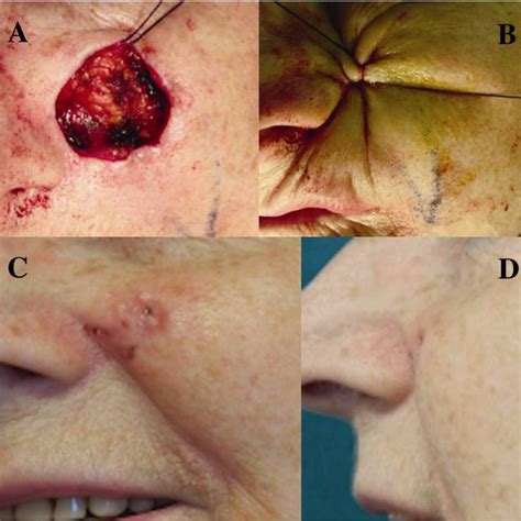 A position or opinion or judgment reached after consideration. (PDF) A simple technique for the excision of cutaneous ...