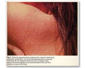 You can get laser treatment for kp in the skin clinic. Laser Hair Removal Keratosis Pilaris | Dorothee Padraig ...