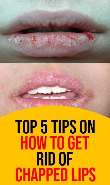 Sunblock lip balm can protect your lips from the sun, a trigger for cold sores. TOP 5 TIPS ON HOW TO GET RID OF CHAPPED LIPS in 2020 | How ...