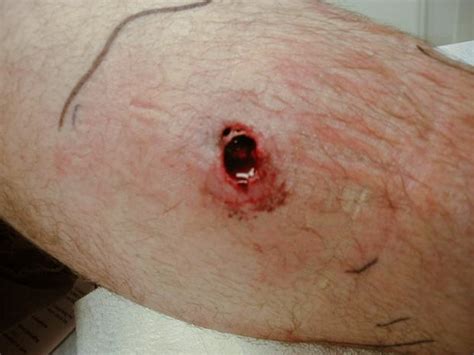 Though fatalities are quite rare in this case, in young. Brown Recluse Spider Bite - Pictures, Symptoms, Stages ...