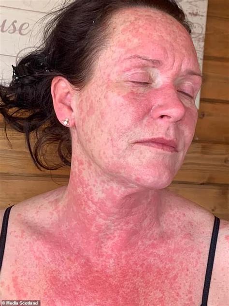 Scientists at pfizer said their extensive trials showed the vaccine is generally well tolerated in all age groups. Mother's arm erupts in agonising red rash after getting ...