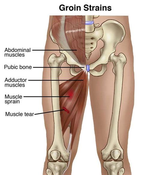 The groin muscles are the ones on the inner thigh that attach to the hip bones. A groin strain is an injury to the groin area, the area of ...