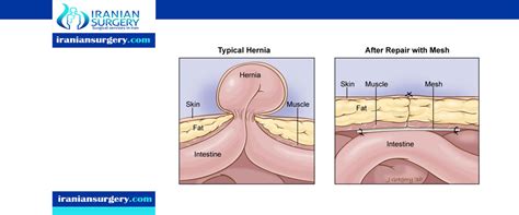 Hernias occur when a weakness in the muscular wall of the abdomen allows organs and tissues to hernias usually occur in the groin, stomach, or belly button. Repairing an umbilical hernia | Iranian Surgery