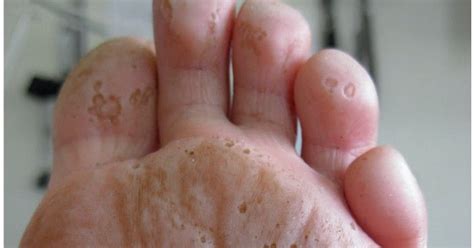 Por ello, el 10% de las afecciones dermatológicas en verano tienen. Consejos del Dermatologo: ¿Hoyitos en los pies?