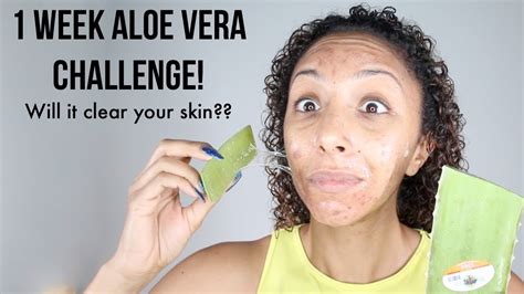 Several remedies are available for acne. 1 WEEK ALOE VERA CHALLENGE! REAL RESULTS! Will it clear ...