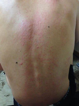 背中全体に、痒みを伴う赤いブツブツが大量に出来ました ...