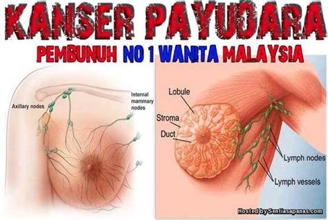 Pada proses kehamilan, sel telur yang. vitamin sana sini : TANDA-TANDA KANSER PAYUDARA YANG PERLU ...
