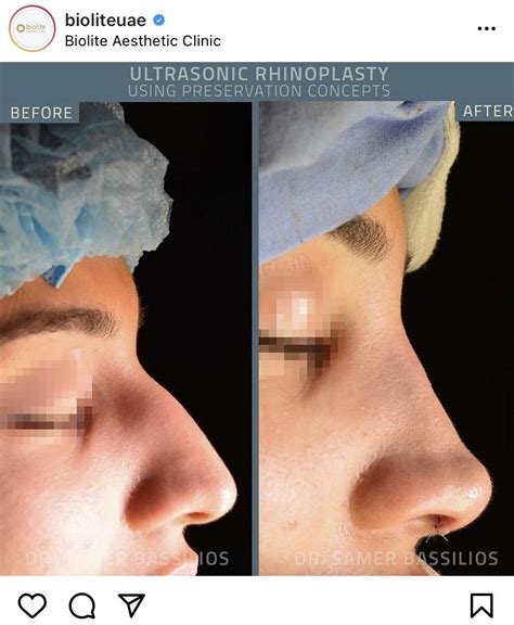 To have an operation to change the shape of your nose 2 (definition of nose job from the cambridge advanced learner's dictionary & thesaurus © cambridge university press). Five Questions To Ask Before Getting A Nose Job - Biolite