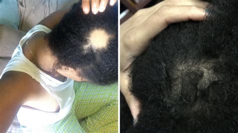 Created to enhance follicle growth in difficult to grow areas of hair. Growing Back My Bald Spot - How To Get Rid Of Bald Spots ...