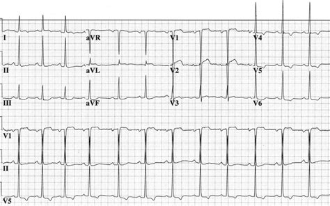 Pengertian depresi depresi adalah salah satu tahap paling buruk dalam gangguan saraf, karena ini merampas begitu banyak keinginan untuk sembuh. EKG Part 8 : ST Elevasi bukan karena Infark Miokard ...