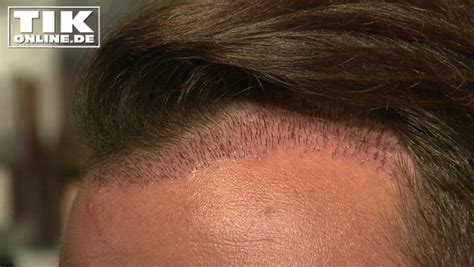 Jun 04, 2021 · rocco stark (35) hat einen neuen look! Rocco Stark nach Haartransplantation „Du kannst auch ...