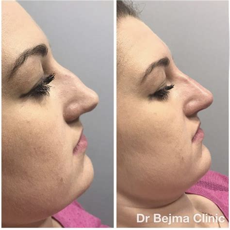 It is a good option for those who are unhappy with the shape of the nose, but are not ready for surgery. Non surgical nose job - Dr Bejma Medical Clinic