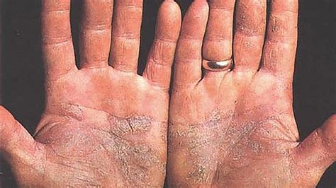 Asma bronquial, epoc, fibrosis quística, fibrosis pulmonar. Lo más temido de la psoriasis son las comorbilidades asociadas | El Correo