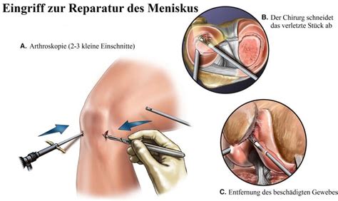 Das erste zeichen für einen meniskus anriss das würde auch die schonhaltung des beines erklären,der komische sitz,usw. Meniskusriss im Knie, Schmerzen, Symptome, Operation, Anriss