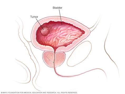 It is a disease in which cells grow abnormally and have. Bladder cancer - Symptoms and causes - Mayo Clinic