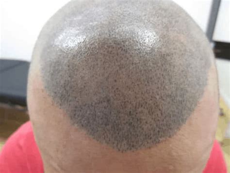 5 Scalp Micropigmentation Regrets + Botched Warnings ...