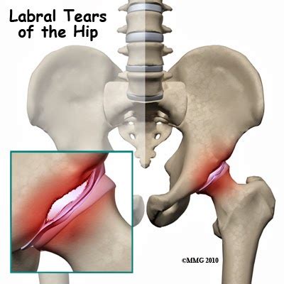 A labrum slap tear is one of many shoulder injuries. Triathlon saved my life.: My Journey through Hip Labrum ...