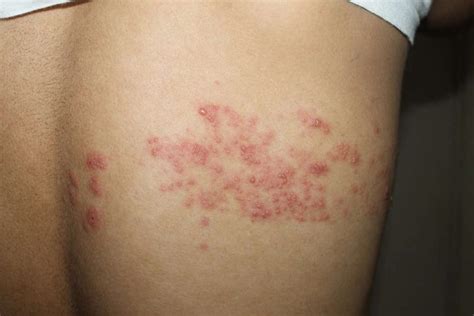 HERPES ZOSTER (SHINGLES) - Miracle Homeo Clinic