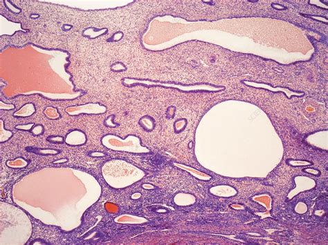 In a normal menstrual cycle, this shedding begins around day 28 and continues into the first few days of the new reproductive cycle. Uterine polyps, LM - Stock Image - C050/6830 - Science ...