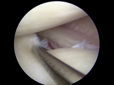 Details on knee surgery meniscus tear costs. Torn meniscus: Causes, symptoms, and recovery