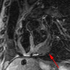 Elle peut s'accompagner ou non d'un épanchement péricardique et en cas de fibrose et calcifications (avec alors épaississement du péricarde) évoluer vers une péricardite constrictive qui gêne le. Exemple de péricardite constrictive pseudotumorale - IRM ...