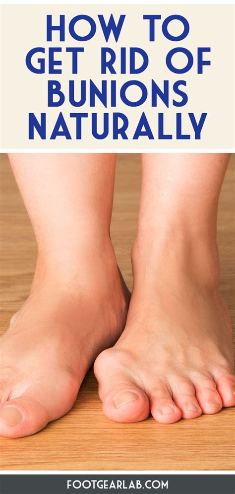 Learn about natural flat feet treatment and prevention methods! How To Get Rid Of Bunions Without Surgery In 12 Easy Ways ...