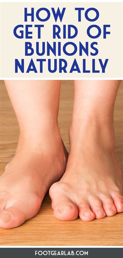 For more information on bunions, i. How To Get Rid Of Bunions Without Surgery In 12 Easy Ways ...