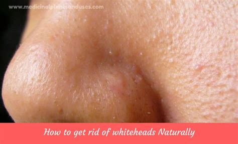We'll be back with an even better deal next time, so stay tuned! Top 18 Home Remedies for Whiteheads on face and nose