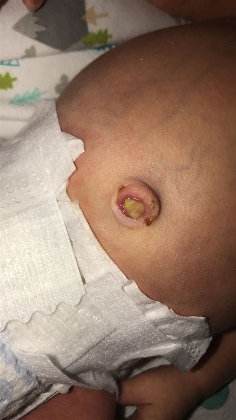 If baby has any unusual lumps in or around their belly button, these may be a belly button hernia. How Many Days Until Babys Umbilical Cord Falls Off - Baby ...