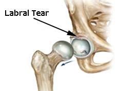 According to estimates, more than 30 million people now regularly practice yoga worldwide. Hip Labral Tears | Pamela Morrison Pelvic Pain Physical ...