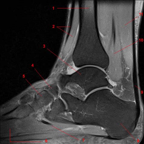 Involved early gray = muscle: MRI of the Ankle: Detailed Anatomy - W-Radiology