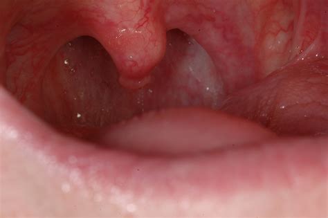 Papilloma sul labbro inferiore - Papilloma sull ugola