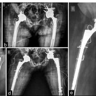 Fic at simon fraser university, vancouver. Vancouver Classification of periprosthetic fractures ...