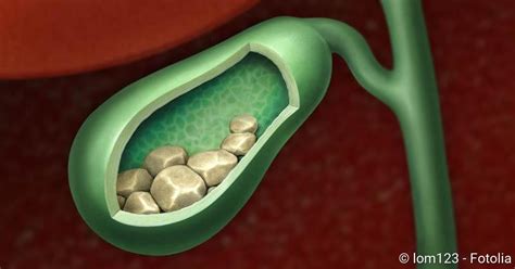 Gallensteine entstehen, wenn sich die gallenflüssigkeit so verändert, dass schwerer lösliche bestandteile wie cholesterin oder. Gallensteine: Beschreibung, Ursachen, Symptome - NetDoktor