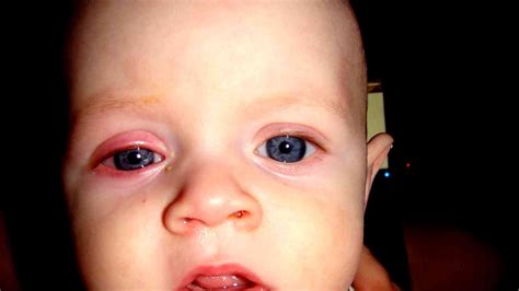 Pink eye (conjunctivitis) is an inflammation or infection of the transparent membrane (conjunctiva) that lines your eyelid and covers the white part of your eyeball. Pink Eye In Infants Pictures - Pink Choices